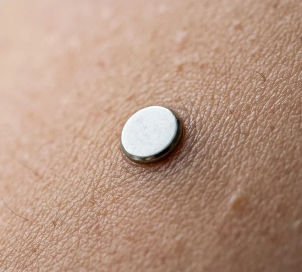 Gros plan d'un implant microdermal dermique sur la peau avec éclairage naturel