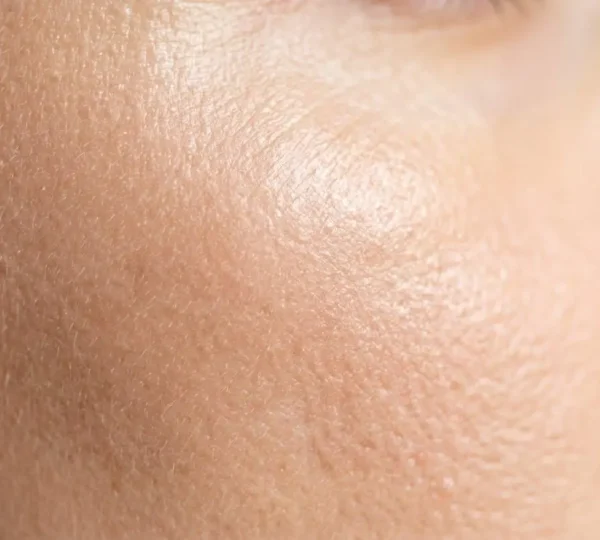 Vue macro de la peau en cours de renouvellement après un peeling chimique
