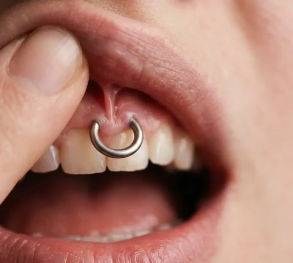 Gros plan sur une lèvre supérieure soulevée révélant un piercing smiley, montrant l'anatomie du frein labial et la zone de contact avec les gencives, dans un style photographique médical